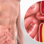 Penyakit Hernia Kenali Gejala, Penyebab Dan Pengobatannya