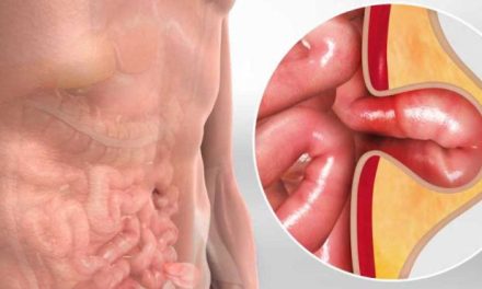 Penyakit Hernia Kenali Gejala, Penyebab Dan Pengobatannya