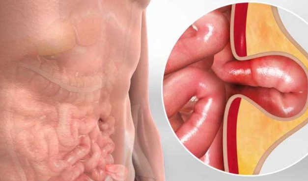 Penyakit Hernia Kenali Gejala, Penyebab Dan Pengobatannya