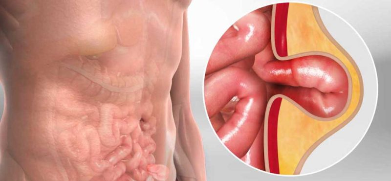 Penyakit Hernia Kenali Gejala, Penyebab Dan Pengobatannya